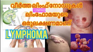 LYMPHOMA മിക്ക ലിംഫോമകളും കീമോതെറാപ്പിയിലൂടെയും ടാർഗെറ്റഡ് തെറാപ്പിയിലൂടെയും സുഖപ്പെടുത്താവുന്നതാണ് [upl. by Ahteres492]