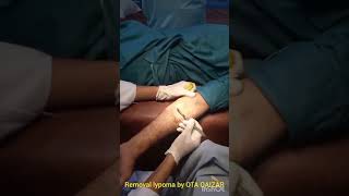 Removal of Lipoma [upl. by Aivalf]