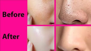 Open Pores And Scars Treatment Ftupasanakiduniya  Open Pores Home Remedy  Himanshu Bhatt [upl. by Herculie]