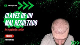 CLAVES DE UN MAL RESULTADO DE TRASPLANTE CAPILAR [upl. by Elysia]