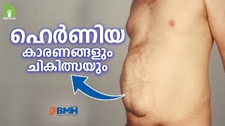 ഹെർണിയ വരാനുള്ള പ്രധാന കാരണം  Hernia Malayalam Health Tips [upl. by Nylareg]