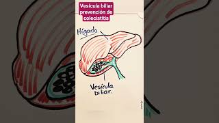 COLECISTITIS DOLOR DE VESÍCULA [upl. by Urian]