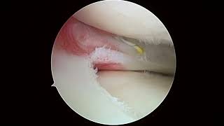 R knee chondroplasty and 6 22 23 VB [upl. by Yelsel]