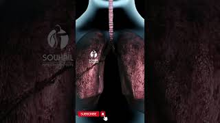 What Is Smoker Lung [upl. by Cyrus227]