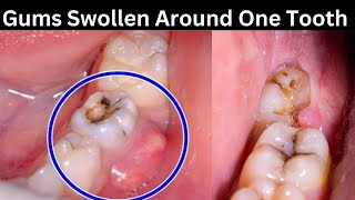 Why is my gums swollen around one tooth [upl. by Ainafets]