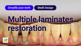 Simplify Your Work  Multiple Laminates Restoration [upl. by Oramug]