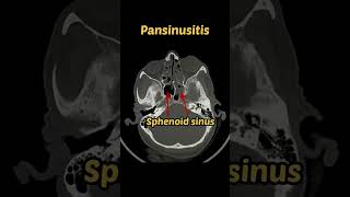 Pansinusitis para nasal sinuses  CT scan  Radiology ctscan sinusitis pns [upl. by Wyn373]