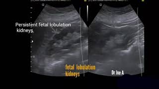 Persistent fetal lobulation kidney ultrasound video [upl. by Itraa481]