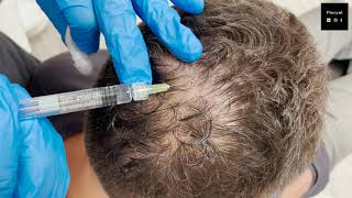 Hair loss Treatment with Pluryal Hair density [upl. by Cindelyn]