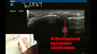 Articolazione acromion clavicolare destra [upl. by Baram875]