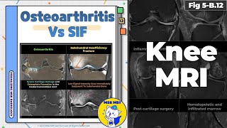 Fig 5B12 Osteoarthritis vs Subchondral Insufficiency Fracture [upl. by Icrad865]