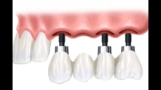 Diş çekimi sonrası implant ve köprü uygulaması [upl. by Adnerak]