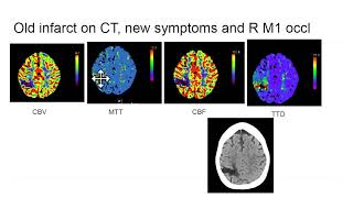 Video 3 of 3 How to Interpret a Brain CT Perfusion Scan for acute stroke [upl. by Nnaeed]