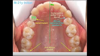 Amazing amp Simplified protocol for retreatment [upl. by Jari]