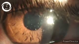 Adenoviral punctate keratitis [upl. by Gona]