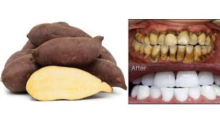 dant saaf kaise kare  dant safed kaise kare  dant majboot karne ke upay teeth whitening treatment [upl. by Yenalem181]