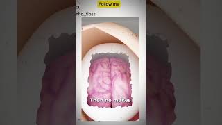 Craniectomy Brain Surgery Explained 🧠 shorts [upl. by Etnwahs402]