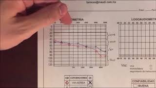 Video de como interpretar una audiometría [upl. by Vernita979]