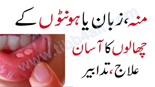 Treatment of mouth blisters  منہ، زبان یا ہونٹوں کے چھالوں کاآسان علاج [upl. by Currie934]