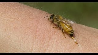 Bee sting acupuncture at Eastern Medical Center by DrLee in Calgary [upl. by Mandel]