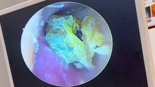 Super thick fungal dry slices in the ear canal [upl. by Matthaus646]