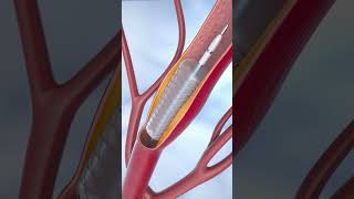 coronary angioplasty and stent insertion 3danimationsurgery anatomy medicalanimation viralvideo [upl. by Tolland691]