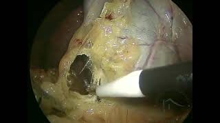 COLECISTECTOMIA POR VIDEOLAPAROSCOPIA  culture of safety in cholecystectomy [upl. by Drews]