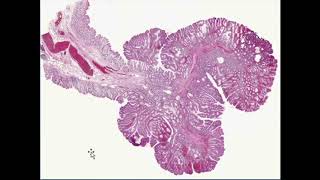 neoplasia robbins pathology full review with combined and enhanced quality [upl. by Maud]