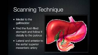 pyloric stenosis [upl. by Ogdon521]