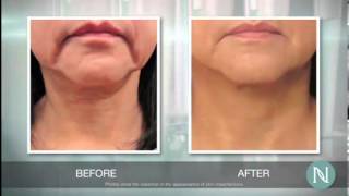 Eliminate Enlarged Pores  How To Reduce Pore Size Quickly  Watch This [upl. by Dorree330]