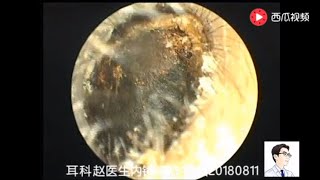 Ear endoscope cleaning the external auditory canal and answering common questions [upl. by Naillimxam851]