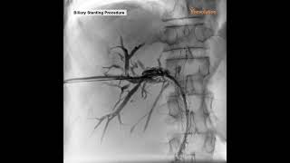 BILIARY STENTING PROCEDURE [upl. by Ahsaten]