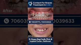 Braces Treatment Timepass  dentist toothdental facts dentalclinic doctor [upl. by Hardin588]