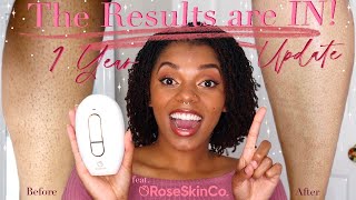 The Results are IN At home laser hair removal 1 Yr Update feat RoseSkinCo Lumi  IPL Journey [upl. by Bonnice59]