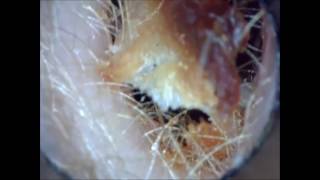 Ear Wax Removal Massive Compilation best of Nick Chitty Part 1 asmr [upl. by Blithe41]