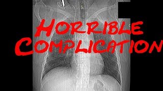 Horrible complication after cardiac intervention Cardiology Forum Echocardiography QuizCase [upl. by Mercuri298]