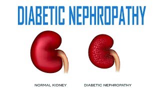 Diabetic Nephropathy  Pathology Causes Symptoms Diagnosis Treatment [upl. by Illak30]