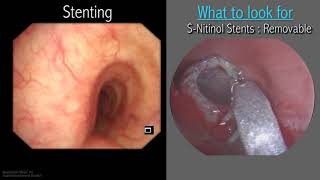 Mastering Bronchoscopy for Thoracic Surgery Chapter 3 [upl. by Eignav832]