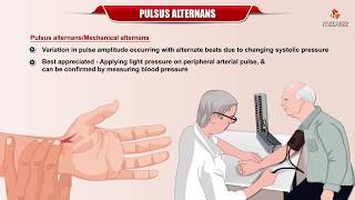 Pulses Alternans  Definition Etiology and Mechanism  Internal medicine  Usmle Cardiology [upl. by Pachton]