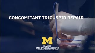 Cardiac Surgery Simplified Concomitant Tricuspid Repair [upl. by Dowlen]