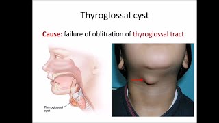 Thyroglossal cyst [upl. by Premer]