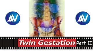 Twin Gestation Part II [upl. by Akeme]