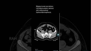 Bilateral renal concretionsLeft distal ureteric calculus with mild proximal hydroureteronephrosis [upl. by Karia34]