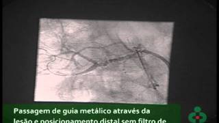 Angioplastia de Artéria Renal [upl. by Nek]