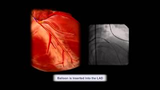 Cardiac Tamponade from PCI resulting in death due to failure [upl. by Ahsiekin]