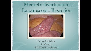 Meckels Diverticulum Laparoscopic resection  Dr Atul Mishra Ludhiana [upl. by Salis806]