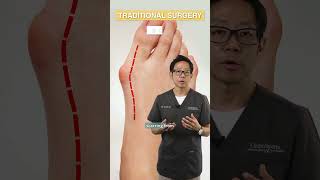 Traditional vs Minimally Invasive Bunion Surgery  MCAShorts [upl. by Tyson]