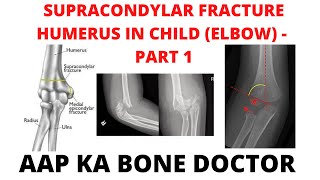 SUPRACONDYLAR FRACTURE HUMERUS IN A CHILD ELBOW  PART 1 EPISODE 27 [upl. by Lucias]