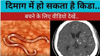 NCC  Neurocysticercosis  दिमाग में कीड़ा न्यूरोसिस्टीसर्कोसिस [upl. by Enidan]