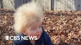 Boy has uncombable hair syndrome [upl. by Ellemac]